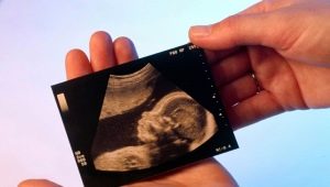 Gebeliğin 12. haftasında ultrason: fetal boyut ve diğer özellikler