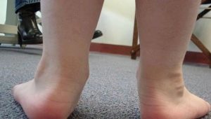 Çocuklarda Varus ayak deformitesi