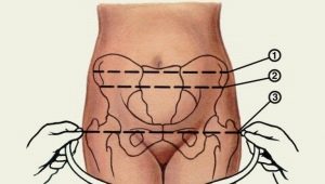 Makitid pelvis during pregnancy at clinical form