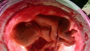 Wat betekent placenta verkalking en in welke vormen is het?
