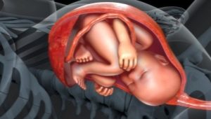 Typen navelstrengbevestiging aan de placenta: normen en risico van afwijkingen