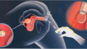 Vad är intrauterin insemination och hur utförs proceduren?
