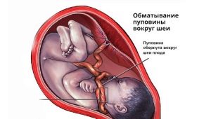 Is het gevaarlijk om de navelstreng rond de nek van de foetus te verstrengelen en welke invloed heeft dit op de bevalling?