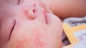 शिशुओं में यूरिकेरिया: लक्षणों से लेकर उपचार तक