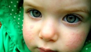 Die Ursachen der Urtikaria bei Kindern verstehen