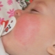 Treatment of diathesis on the cheeks in a child