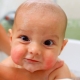 유아의 아토피 성 피부염