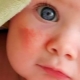 كيف يبدو التهاب الجلد عند الأطفال؟