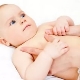 Symptoms and treatment of umbilical hernia in children