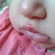 Herpes op de lip van de baby