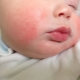 Hoe ziet de huidallergie van een baby eruit?
