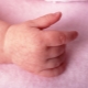 Marmeren huid bij zuigelingen en pasgeborenen: oorzaken, symptomen en behandeling