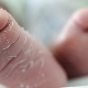 Wat te doen als de huid van een pasgeborene schilferig is?