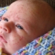 Hormonal rash in newborns and infants