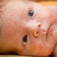 신생아 및 유아에서 가시적 인 열의 증상 및 치료