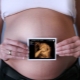 임신 중 3D 초음파