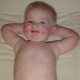 ماذا لو كان هناك طفح جلدي في جميع أنحاء جسم الطفل ، وليس هناك درجة حرارة؟