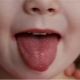 Какво да направите, ако детето има обрив в устата?