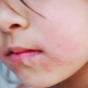 Cosa succede se c'è irritazione o eruzione cutanea intorno alla bocca del bambino?
