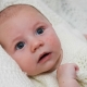 كيف نميز بين فقدان الحرارة والحساسية عند الرضع؟