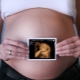 Oorzaken, behandeling en effecten van oligohydramnion tijdens de zwangerschap