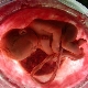 Vôi hóa nhau thai có nghĩa là gì và ở dạng nào?