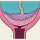 Vad betyder fullständig placenta previa och hur är det farligt under graviditeten?