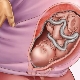 Vad är låg previa under graviditeten och är det farligt?