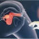 Čo je intrauterinná inseminácia a ako sa postupuje?