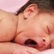 Lanugo in newborns
