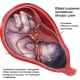 Göbek kordonunu fetüsün boynu etrafına dolaştırmak tehlikeli midir ve doğumu nasıl etkiler?