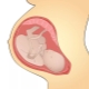 Funktioner av effekten av en kort navelsträng vid graviditet och förlossning