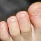 Какво да правите, ако ноктите на краката на детето се счупят или счупят?