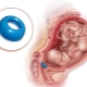 Funktioner av förlossning efter avlägsnande av pessar