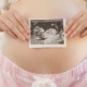 ولادة في 29-31 أسبوعا من الحمل