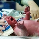 Nyfödd asfyxi: från orsak till effekt