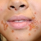 Streptoderma in children: from symptoms to treatment