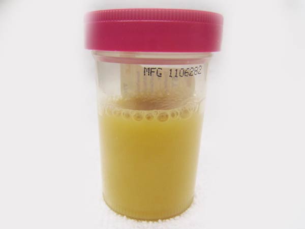 Weiße stücke im urin