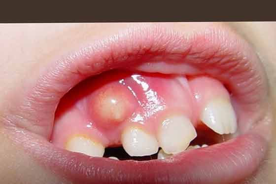 Stomatitis In Children On The Gums 8 Photos The Gums Bleed Inflamed