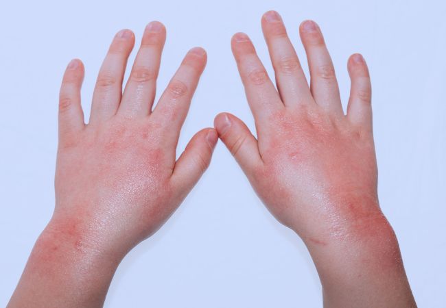 Ano ang hitsura ng allergic na pantal sa mga bata (27 mga larawan): iba