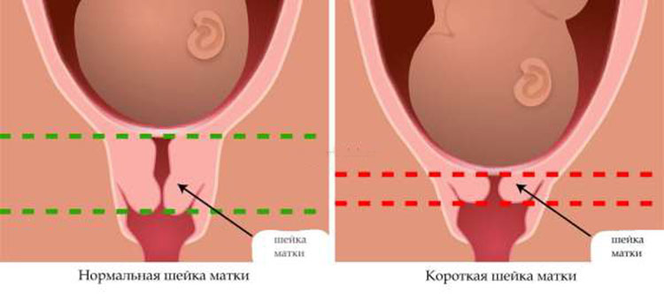 الرحم العنقي أثناء الحمل المبكر 23 صورة لشكله وكيف يجب أن يكون في بداية الحمل