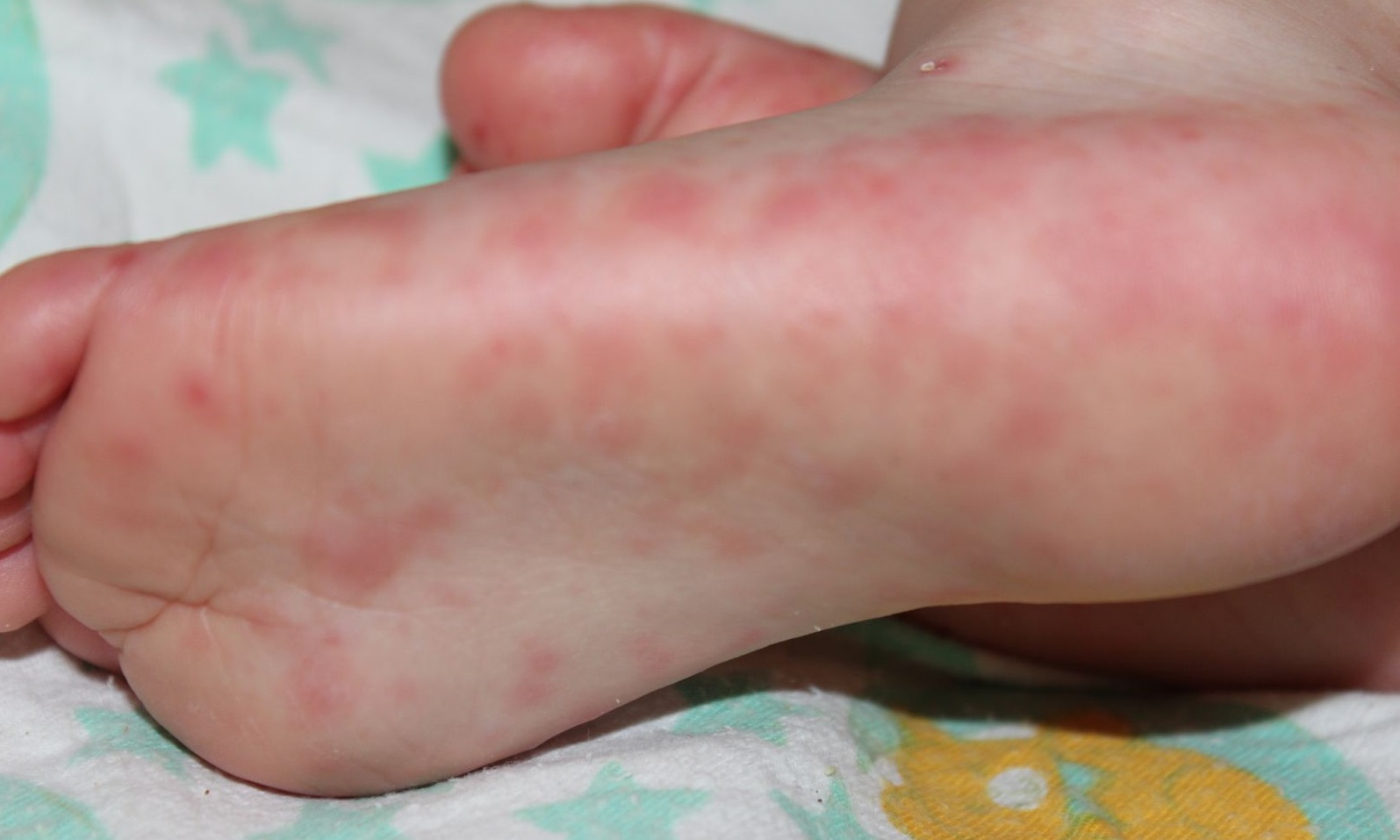 Rash On The Palms And Feet Of A Child 34 Photos What To Do If There