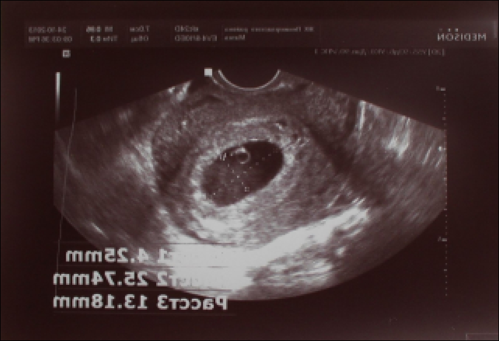 11 tjedana trudnoće skeniranje speed dating jacksonville beach