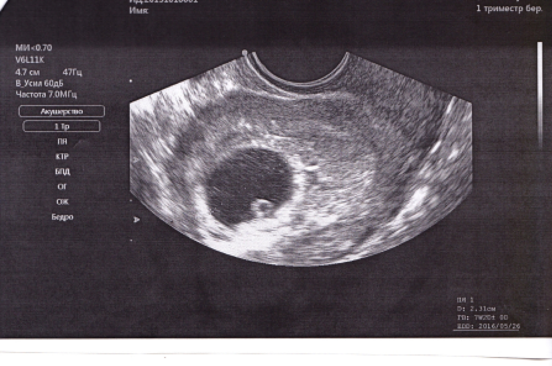 5 недель можно делать. Снимок УЗИ эмбриона на 8 неделе беременности. Плодное яйцо на УЗИ 7 недель беременности. УЗИ 2 на 5-6 недели беременности. Плодное яйцо на 6 неделе беременности УЗИ.