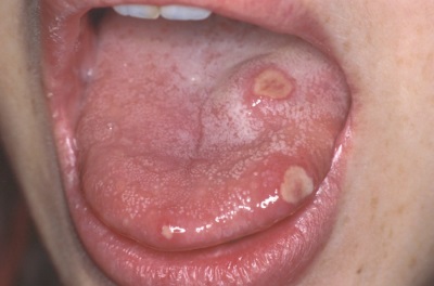 Stomatitis in de tong