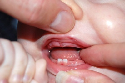 아기의 이빨이 등반 중이다.
