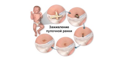 Liečivé pupok novorodenca