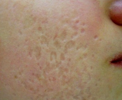 Ano ang hitsura ng chickenpox (17 larawan): pantal mula sa bulutong